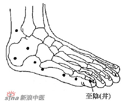 胎位不正 试试艾灸“至阴穴”